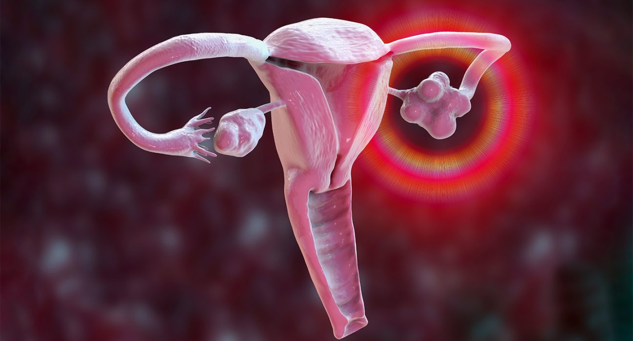 An illustration of a uterus, fallopian tubes and ovaries shows an inflamed, cyst-filled ovary on the right side due to PCOS, while the ovary on the left appears normal.