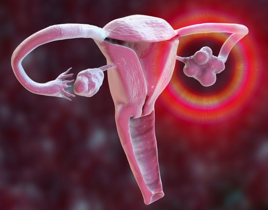 An illustration of a uterus, fallopian tubes and ovaries shows an inflamed, cyst-filled ovary on the right side due to PCOS, while the ovary on the left appears normal.