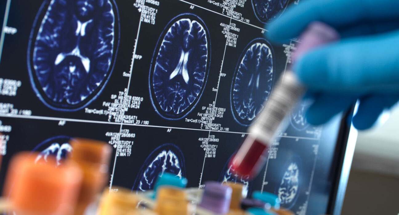 A vial of blood is put into a tube rack, with medical images of a brain in the background.