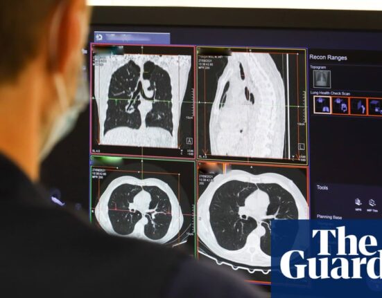 ‘Amazing’ trial shows drug combination stops lung cancer advancing for longer | Lung cancer