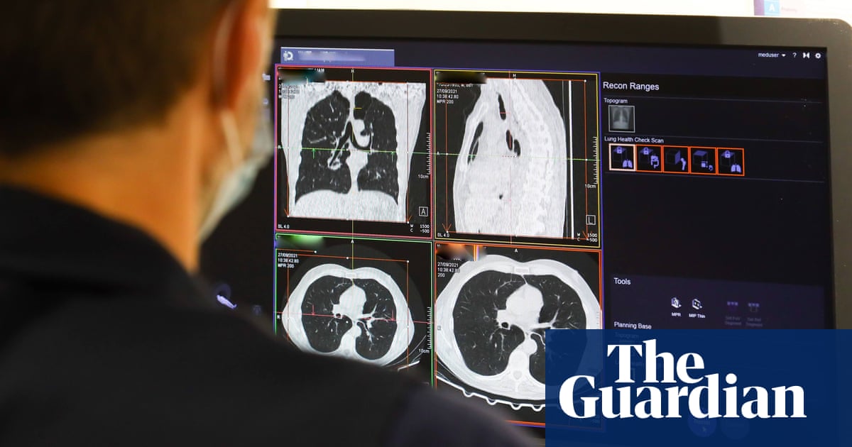 ‘Amazing’ trial shows drug combination stops lung cancer advancing for longer | Lung cancer